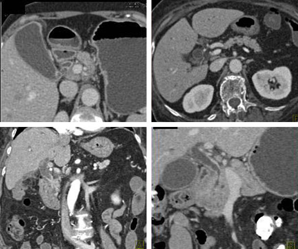 CBD Cholangiocarcinoma CT Findings