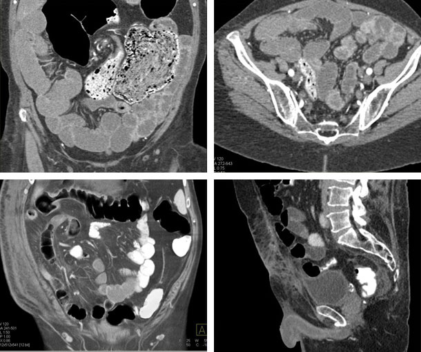 Cecal Volvulus CT Findings