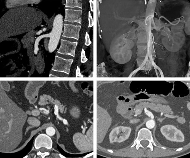 Celiac Artery Dissection CT Findings