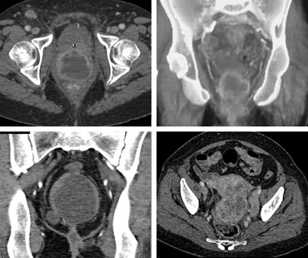 Cervical Cancer CT Findings