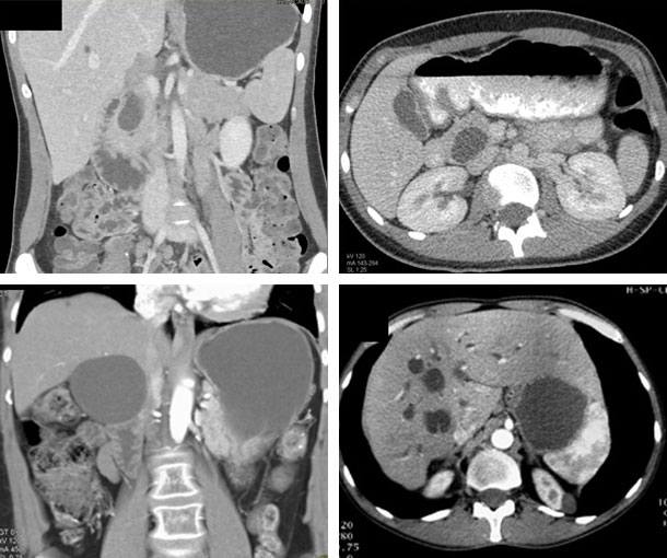 Choledochal Cyst CT Findings
