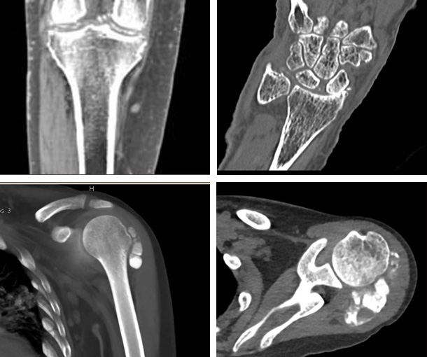 Chondrocalcinosis CT Findings