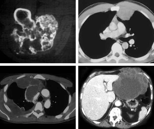 Chondrosarcoma CT Findings