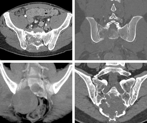 Chordoma CT Findings