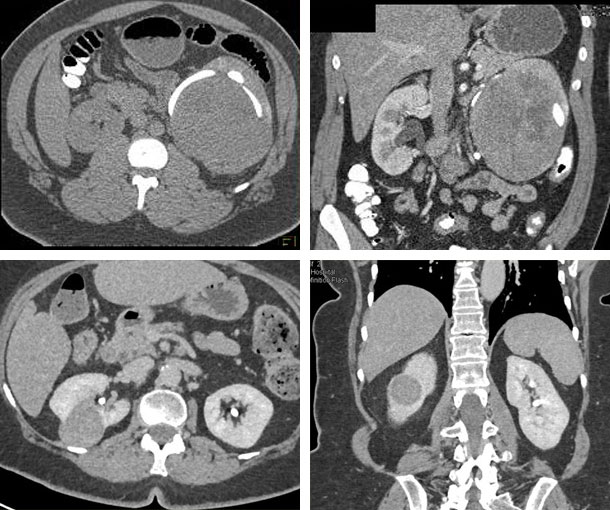Chromophobe RCC CT Findings