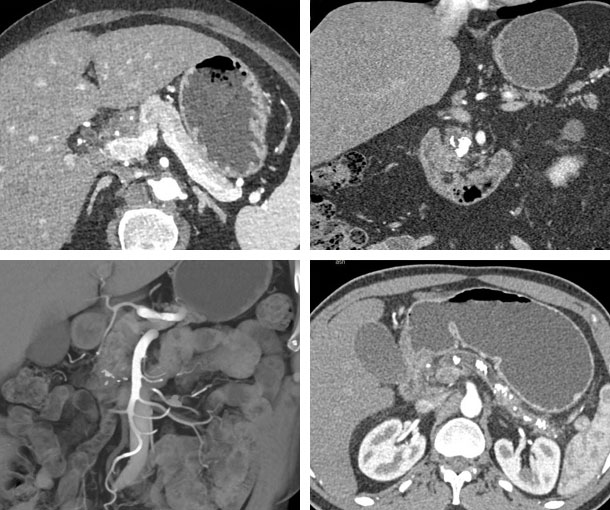 Chronic Pancreatitis CT Findings