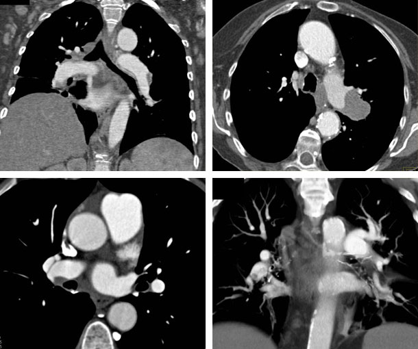Chronic Pulmonary Embolism (PE) CT Findings