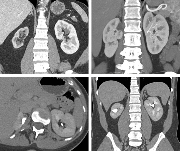 Chronic Pyelonephritis CT Appearance