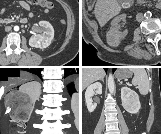 ccRCC CT Findings