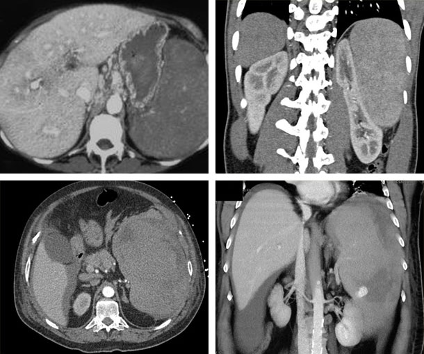 Chronic Lymphocytic Leukemia (CLL) CT Findings
