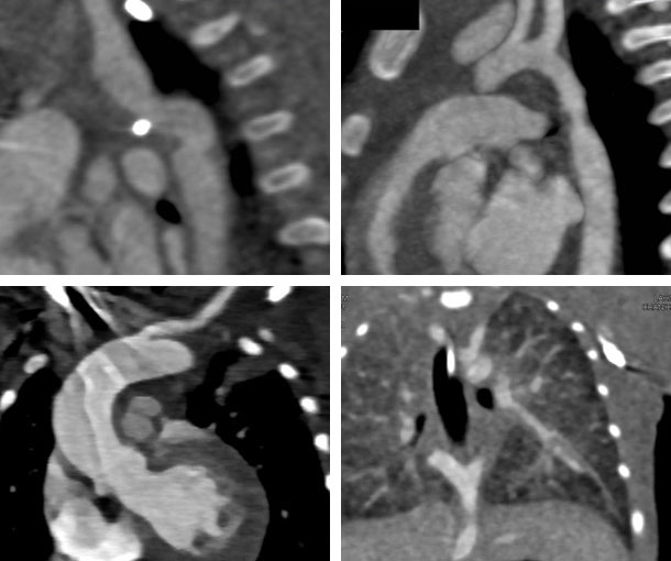 Aortic Coarctation CT Findings