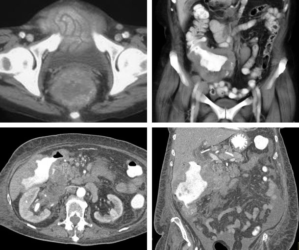 Colorectal Lymphoma CT Findings