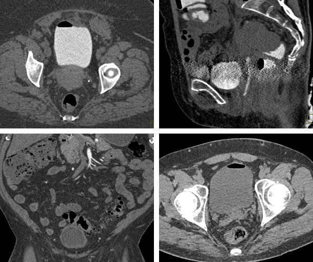 Colovesical Fistula CT Findings