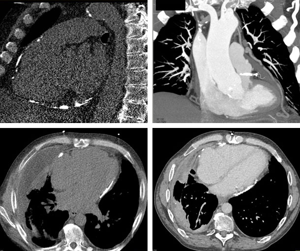 Constrictive Pericarditis CT Findings