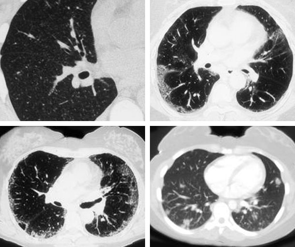 Cryptogenic Organizing Pneumonia (COP) CT Findings