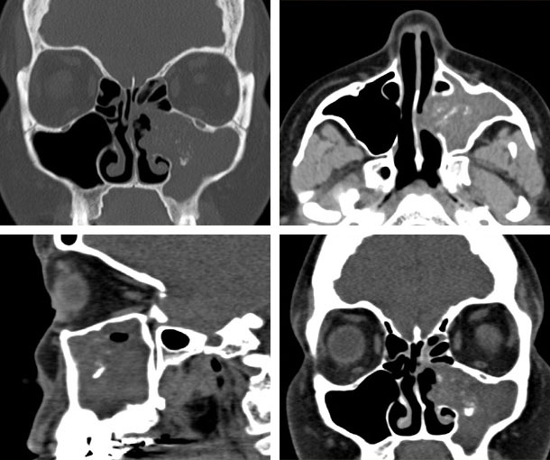 Cranial Mycetoma CT Findings