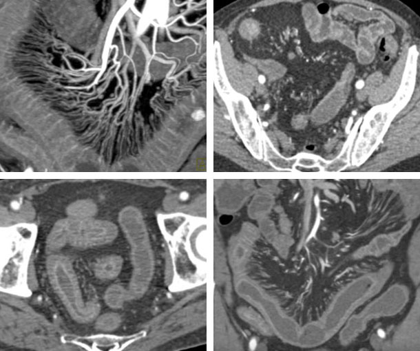 Crohn's Disease CT Findings