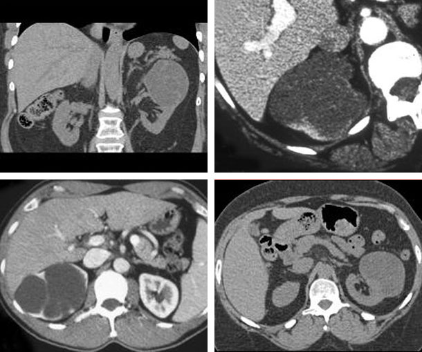 Cystic Nephroma CT Findings