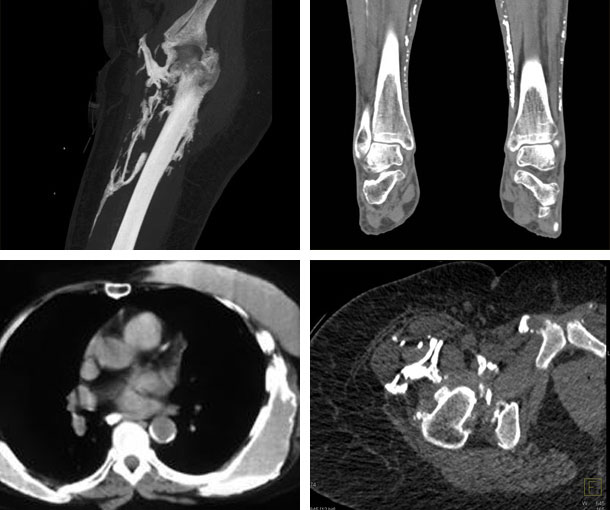 Dermatomyositis CT Findings
