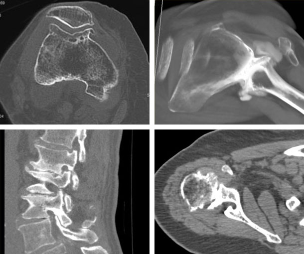 Degenerative Joint Disease (DJD)/Osteoarthritis CT Findings