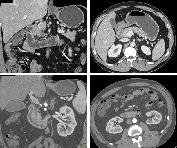 Duodenitis CT Findings