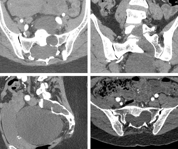 Dural Ectasia