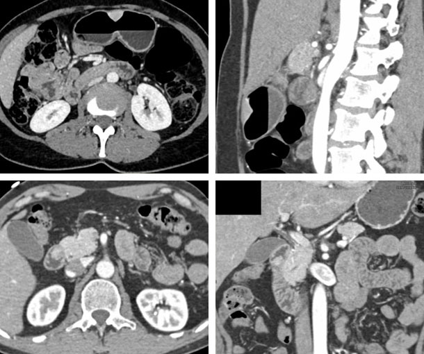 Ectopic Pancreas CT Findings