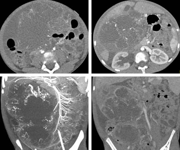 Embryonal Sarcoma CT Findings