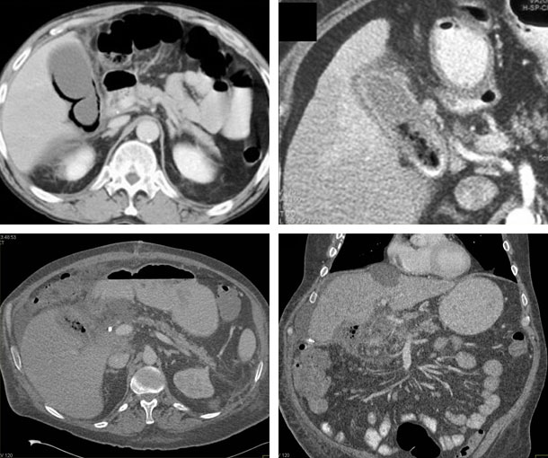 Emphysematous Cholecystitis CT Findings