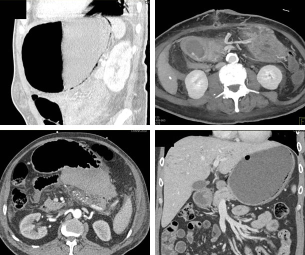 Emphysematous Gastritis CT Findings