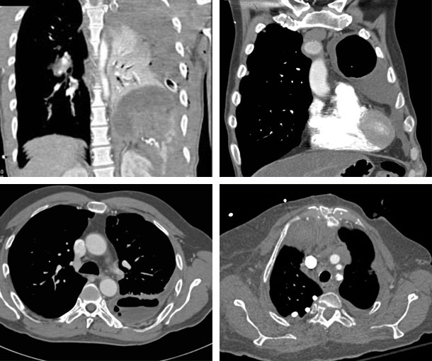 Empyema CT Findings