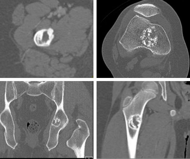 Enchondroma CT Findings