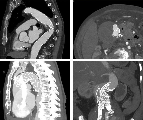 Endoleak CT Findings
