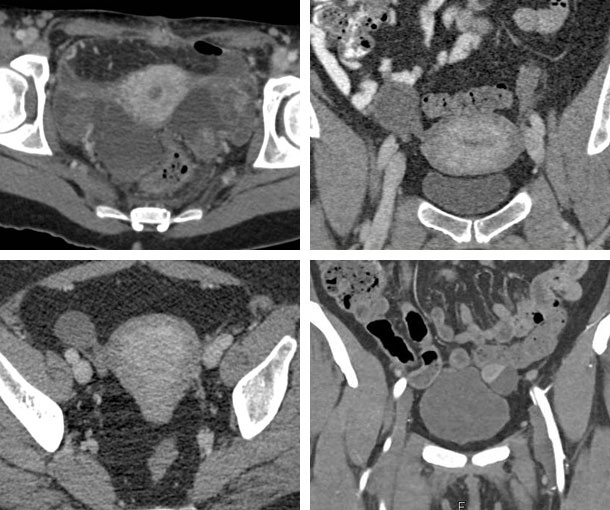 Endometriosis CT Findings