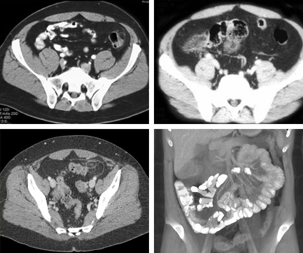 Epiploic Appendagitis CT Findings
