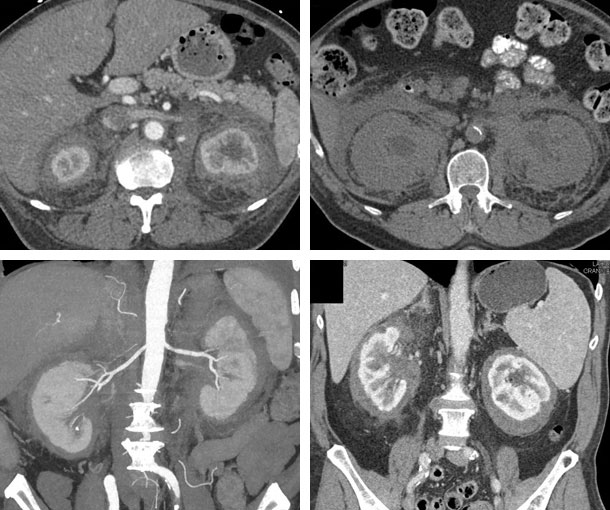 Erdheim-Chester CT Findings