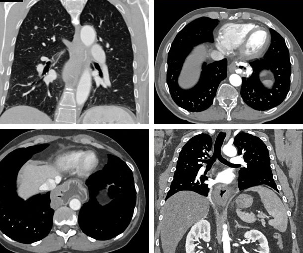 Esophageal Cancer CT Findings