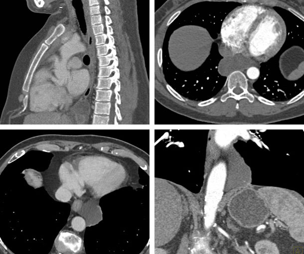 Esophageal Duplication Cyst CT Findings