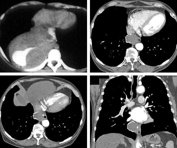 Esophageal Leiomyoma CT Findings