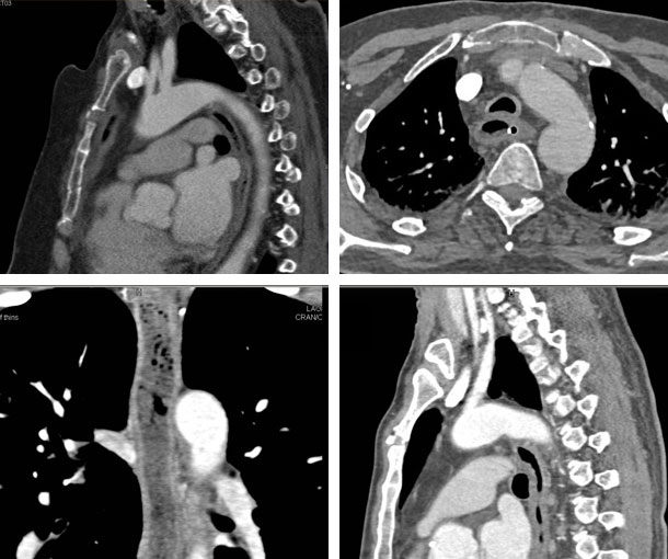 Esophagitis CT Findings