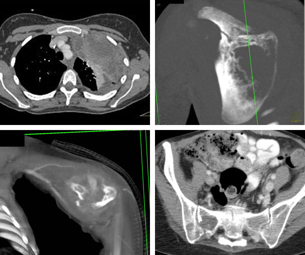 Ewing Sarcoma CT Findings