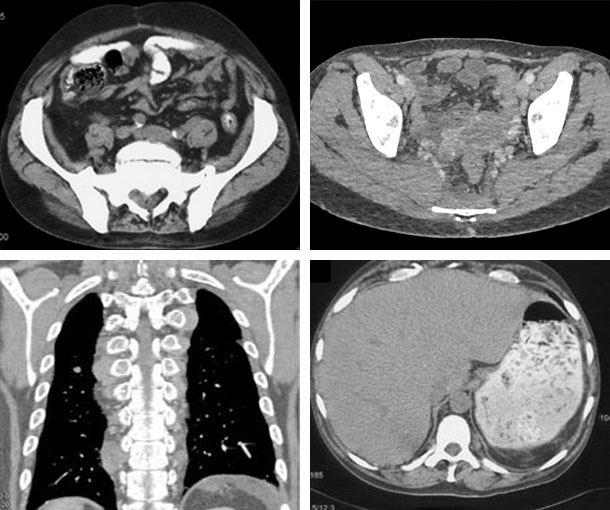 Extramedullary Hematopoiesis (EMH) CT Findings