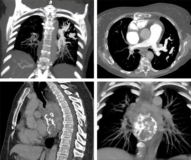 Fibrosing Mediastinitis CT Findings
