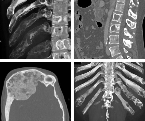 Fibrous Dysplasia