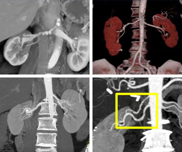 Fibromuscular Dysplasia (FMD) CT Findings