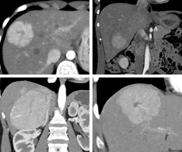 Focal Nodular Hyperplasia (FNH) Syndrome CT Findings