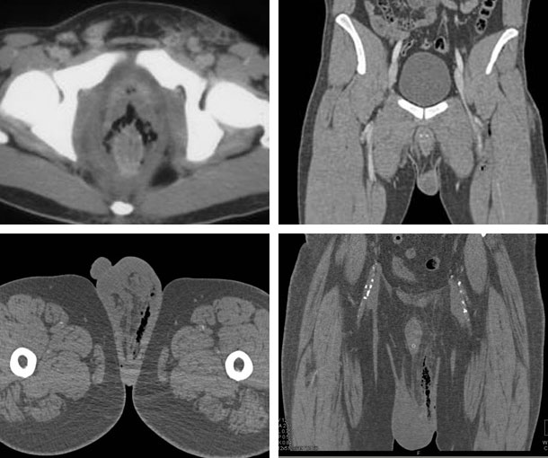 Fournier Gangrene CT Findings