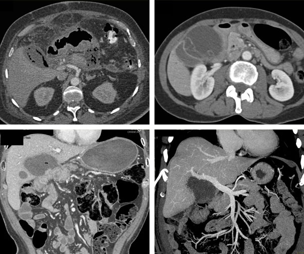 Gallbladder Abscess CT Findings