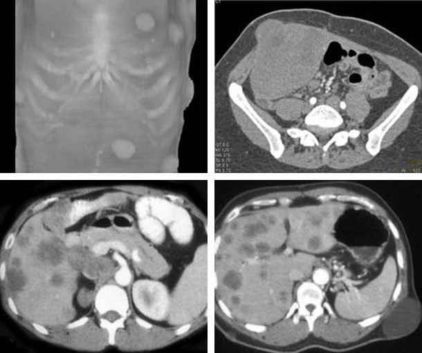 Gardner Syndrome CT Appearance