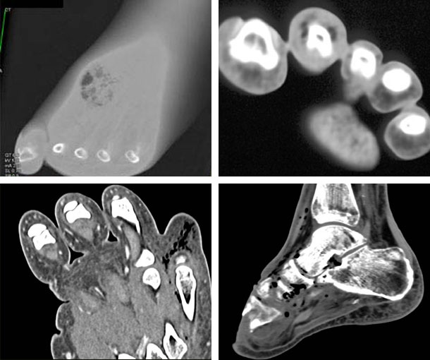 Gas Gangrene CT Findings